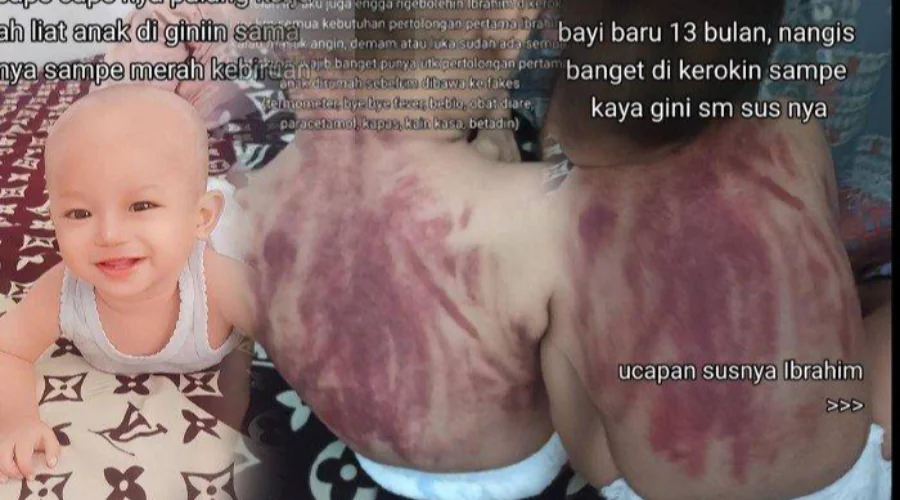 Gambar Artikel Viral Balita Dikerokin Sampai Merah, Ini Kata Dokter Anak UM Surabaya