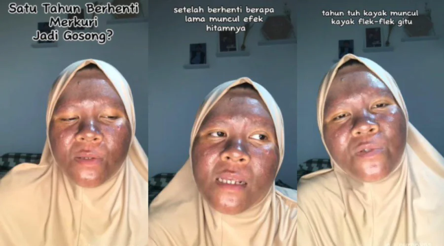 Gambar Artikel Viral Wajah Wanita Gosong Gegara Skincare Bermerkuri, Dosen FK UM Surabaya Berikan Tanggapan